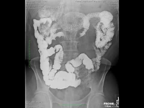Normal Small Bowel Follow Through