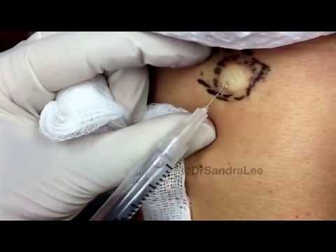 Excision of one of two lipomas: Part I. For medical education- NSFE.