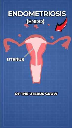 Scientists Create World's First Blood Test for Endometriosis