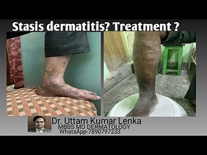 What is stasis dermatitis/treatment/prevention?