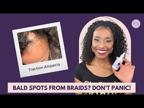 BALD SPOTS FROM BRAIDS? DON'T PANIC!