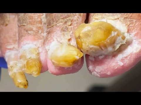 Toenails Like Yellow Stones, Wonderful Pedicure Process【Dr Liu's Pedicur】