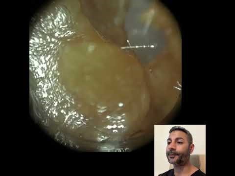 456 - Very Sticky Blocked Ear Wax Removal using the WAXscope®