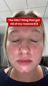 983K views · 424 reactions | Tried everything to get rid of rosacea? 掠 Meet The Red Set, a two-step prescription treatment that targets redness, inflammation, and acne-like bumps caused by rosacea. Formulated by dermatologists with powerful yet gentle ingredients even for sensitive skin. See results in as little as 2 months or your money back! Get started 100% online at Musely.com! | Musely | Facebook