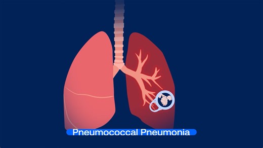 Pneumococcal pneumonia is the most common type of bacterial pneumonia, and its impact can be serious—it can disrupt your life for weeks and, when severe, may require hospitalization. Adults 19-49 with certain underlying medical conditions like lung disease, heart disease, diabetes, and those who smoke cigarettes are especially vulnerable. All adults aged 50 and older are also at increased risk for pneumococcal pneumonia. Learn more about your risk and how to help prevent this potentially serious