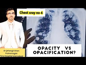Understanding Chest X-Rays: A Comprehensive Guide #cxr #chestxray#xray