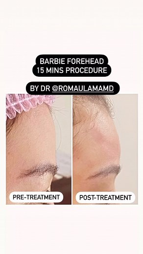 Procedure: FOREHEAD AUGMENTATION also known as BARBIE FOREHEAD...