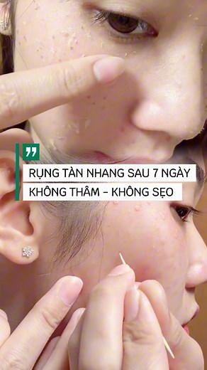 29K views · 214 reactions | SẠCH TẬN GỐC TÀN NHANG ĐƠN GIẢN TẠI NHÀ #nám_tàn_nhang_đồi_mồi #chấm_tàn_nhang #chấmTCA #chấm_tàn_nhang #pellda #đốm_nâu Huỳnh Dương | Trần Tấm | Facebook