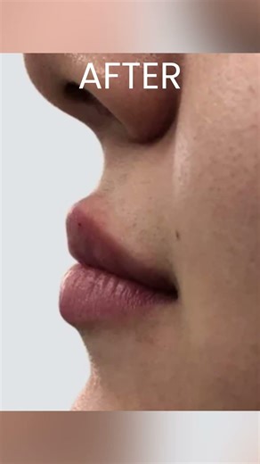 Lip Filler Transformation! Before and After Results