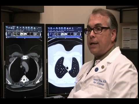 Low-Dose CT for Lung Cancer Screening - UF Health Jacksonville