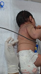 Spinal Galant Reflex Test 😱 #shorts #babycare #nicubaby #neonatalcare #medicalshorts #healthshorts | Gautam Ashish