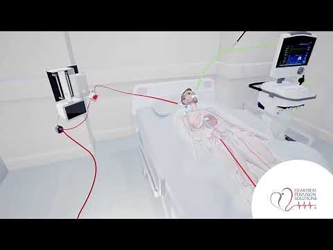 ECMO and Mechanical Ventilation