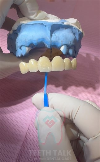 A fixed bridge replaces missing teeth with a natural-looking, permanent solution. 🦷 | Teeth Talk by Dr. Mich Dental Care