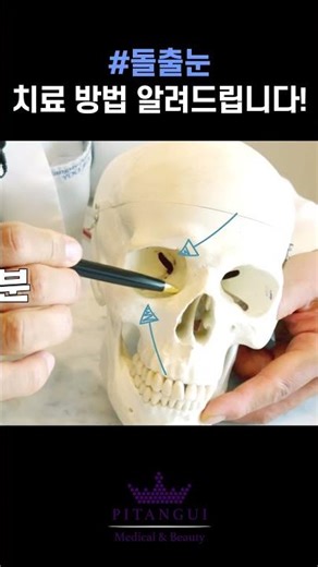 Q. 돌출눈수술! 눈 뼈 없어지면 문제 생기지 않나요?
