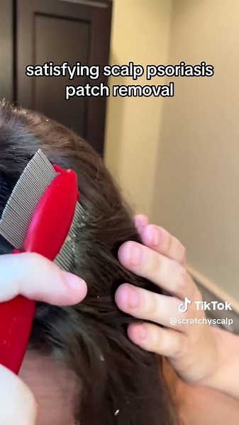 2022 videooooo :))) #psoriasis #scalppsoriasis #psoriasisremoval #satisfyingremoval #Psoriasispatches #scalppsoriasisremoval #Psoriasispatches #scalppsoriasisremoval #psoriasisawareness #psoriasismanagement #psoriasiscommunity #psoriasistreatment #psoriasishelp #psoriasistok #psoriasissatisfying