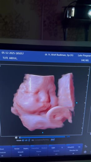 PROMO Akhir Tahun! USG 4D HD Live video masuk hp sampai 31 Desember 2025. Buruan reservasi sekarang ibuibu👍 #usg4d #usg4dimensi #usg4dlampung #promousg #fyp