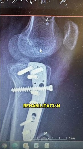 De la fractura a la recuperación: rehabilitación de meseta tibial