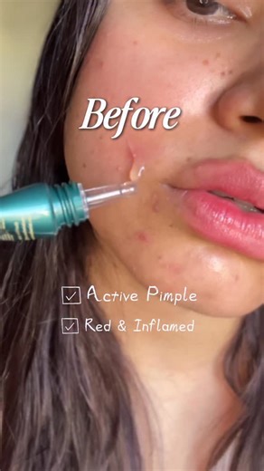 Sasha Singhania 💸 on Instagram: "Comment for the links 🔗💚 Product Description : A powerhouse acne spot treatment that does it all, dries out active zits, unclogs pores, calms inflammation and fades dark spots. This clear gel packs a punch with Sulphur, Salicylic Acid & Azelaic Acid for visible results in hours, not days. How To Use? 1.Apply a small amount directly to the breakout. 2.Use 2–3 times a day for best results. 3.Apply sunscreen after using this cream. Suitable for AM & PM use. Can b