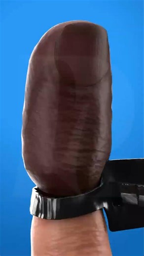 Zip Tie on Finger Causes Dry Gangrene