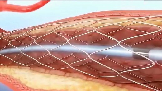 冠脉支架植入术PCI 3D动画展示