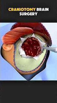 Brain Surgery: Craniotomy Step-by-Step (3D Medical Animation)
