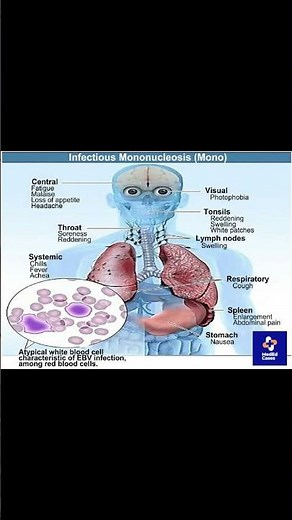 Infectious Mononucleosis Explained in 60 Seconds #pediatrics #meded #medical #infectiousdiseases
