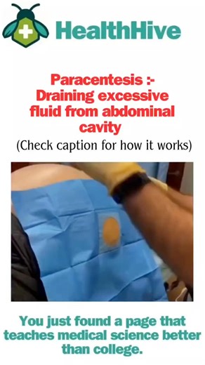 HealthHive on Instagram: "Paracentesis: Draining Fluid from the Abdomen for Diagnosis and Relief Paracentesis is a vital medical procedure where a needle or catheter is used to remove excess fluid that has accumulated in the peritoneal cavity—the space within the abdomen that contains the intestines, liver, and other organs. This fluid buildup is known as ascites. Why is it performed? The procedure serves two main purposes: 1. Therapeutic Paracentesis: To relieve pressure and discomfort caused b