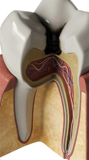 Dental caries | 3d model #vray #corona