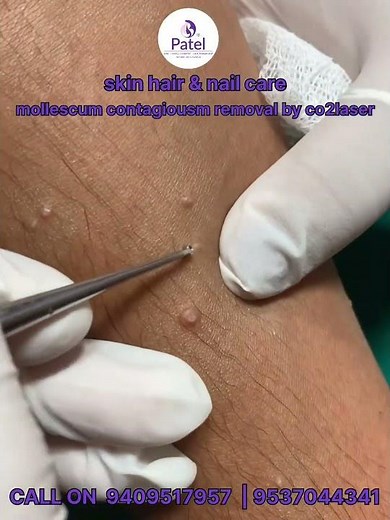 mollescum contagiousm removal/co2 laser/laser treatment/dermatologist Surat