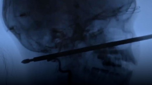 Doctor explains how boy survived having head impaled by meat skewer