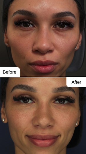 ✨Are you curious about Mono threads as a treatment for under eyes? It can be beneficial for minimizing fine lines, wrinkles and decreasing dark circles, giving you a refreshed appearance. ✨ 👁️ Here are some key benefits: ✅ Costs about the same as under-eye fillers. ✅ Quick procedure, taking under 30 minutes to complete. ✅ Minimal to no downtime ✅ Not painful, mild discomfort during the treatment. ✅ Long-lasting results, with effects lasting 2-3 years based on the individual. ➡️ We look forward