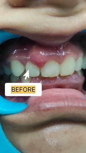 Periodontal Abscess: a localized accumulation of pus within the gingival wall of a periodontal pocket Here's a before and after image of a patient suffering from periodontal abscess Book your appointment now 📲 . . #dental #dentist #dentistry #teeth #gums #surgery #oralhealth #oralhygiene #oralcare #dentalhealth | Dr Pahwa's Centre For Dental Excellence