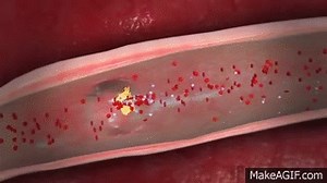 3D Medical Animation - What is a Heart Attack? on Make a GIF