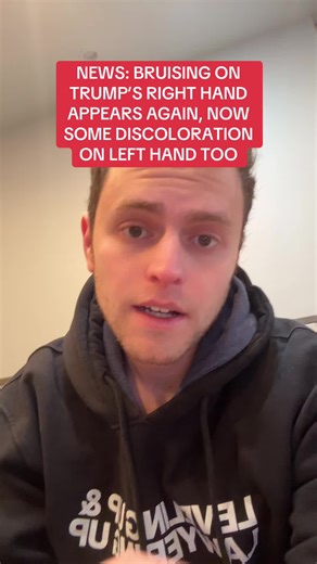 Donald Trump Bruising Updates: December 28 News