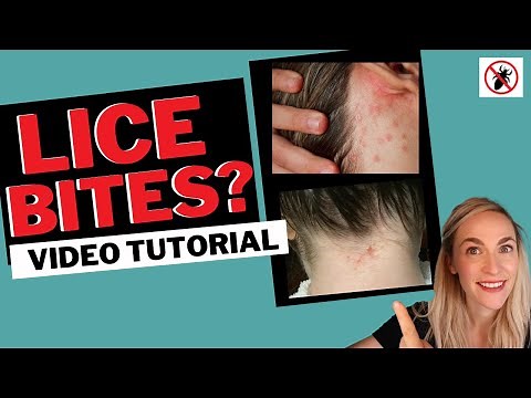 Lice Bites Tutorial