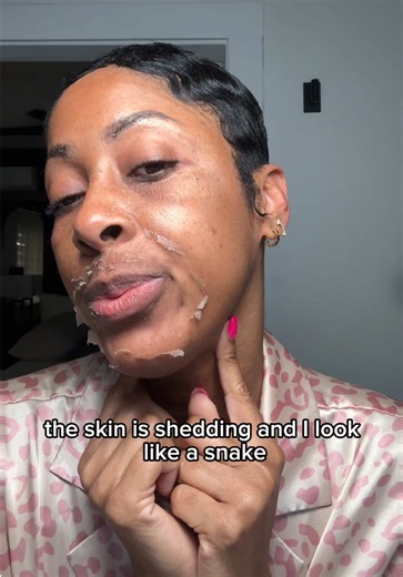 Chemical peels are one of my favorite treatments for skin rejuvenation and anti-aging. They help to exfoliate dead skin, improve pigmentation, texture, and fine lines, and reveal brighter, healthier skin underneath. Think of it as a reset for your skin. The peeling phase usually lasts 3–7 days depending on your skin. Mine lasted about 6 days with lighter peeling, but everyone’s experience can vary. Some people peel more heavily, and some may need multiple peels in a series if we’re targeting con
