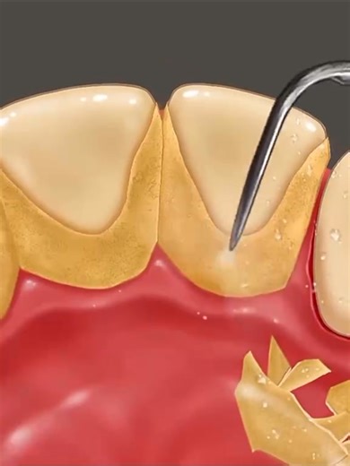 🦷 Here, You’ll See How a Deep Cleaning (Oral Prophylaxis) is Done Unlike regular cleaning, deep cleaning focuses on areas that brushing and flossing cannot reach, helping protect your gums and teeth before problems become serious. ✨ Deep cleaning helps to: ✔ Remove hardened tartar and plaque ✔ Reduce gum bleeding, swelling, and tenderness ✔ Improve persistent bad breath ✔ Prevent the progression of gum disease ✔ Support long-term oral health You may need deep cleaning if you notice bleeding gum