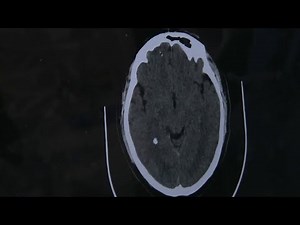 Stem cell trial for stroke recovery