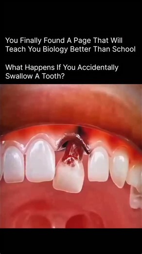 BIOLOGY | MEDICAL | HEALTH on Instagram: "Swallowing a tooth sounds scary—but in most cases, it’s not dangerous. Here’s what actually happens inside your body 👇 🦷 1. It Enters the Digestive System Once swallowed, the tooth travels through: Esophagus → Stomach → Intestines A tooth is small and hard, so your body treats it like any other swallowed object. ⏳ 2. Usually Passes Naturally ✔️ In 90–95% of cases, the tooth passes through the digestive tract ✔️ It exits your body naturally within 2–7 d