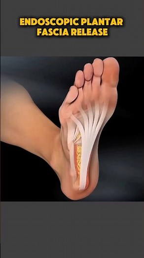 Endoscopic Plantar Fascia Release Surgery #plantarfasciitisrelief #endoscopic