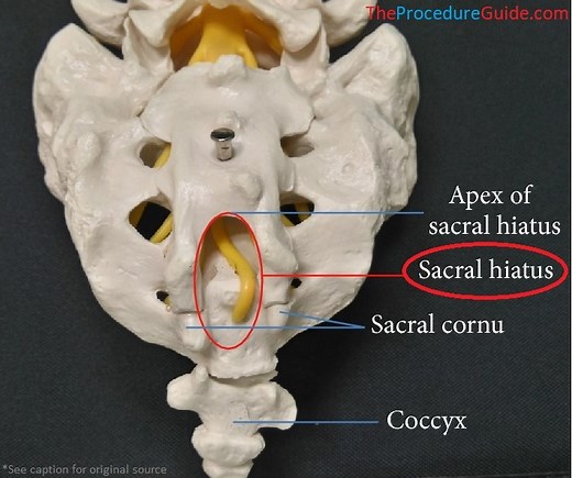 Fluoroscopic Guided Caudal Epidural Steroid Injection – Technique and Overview - The Procedure Guide