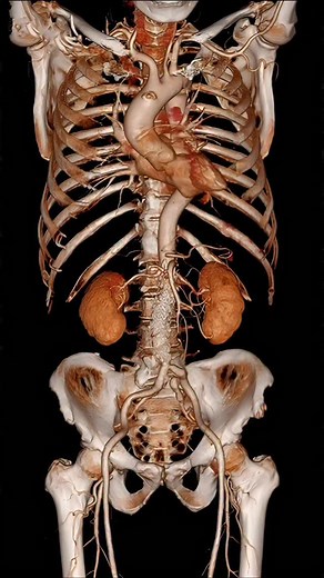 𝐑𝐓.𝐌𝐨𝐡𝐚𝐲𝐦𝐞𝐧 on Instagram‎: "CTA 3D Volume Rendering of the Torso Vasculature and Aorta ☢️ تصوير الأوعية المقطعي المحوسب CTA عرض حجمي ثلاثي الأبعاد لجذع الجسم والأبهر☢️ . . . . . . #radiology #xray #medicine #ct #explore #explorepage #اشعة #طب"‎