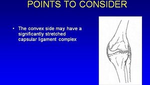 Managing Special Valgus Deformity