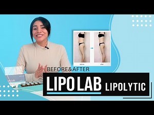 Lipo Lab Fat Dissolving Injections | Before & After Results