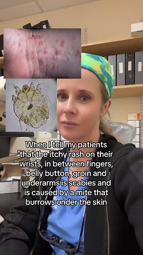 Dr. Abigail Waldman, MD FAAD on Instagram: "Scabies is a common parasite that loves the folds of the skin. It digs under the skin creating a “burrow”- a short track on the skin shown with the arrow. Treatment is topical permethrin or oral ivermectin. Follow if you feel itchy now #scabies #itching #dermatology #fyp"
