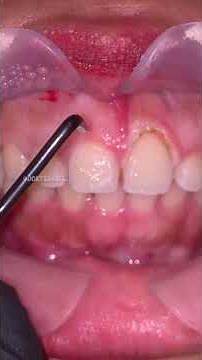 Electrocautery Gingivectomy.