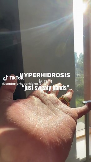 Hyperhidrosis is NOT just sweaty hands. Hyperhidrosis is NOT caused by anxiety. Hyperhidrosis is NOT caused by weight. Hyperhidrosis is NOT caused by heat. Hyperhidrosis is NOT your fault. Hyperhidrosis is often misunderstood and downplayed by those who assume it is “just sweaty hands” — Those with the condition understand how much it truly impacts your daily life. If you are suffering from hyperhidrosis, you are not alone. Here at The Center for Hyperhidrosis, we treat both palmar and plantar h