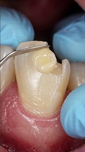 How to Fix a Broken Tooth | Dental Treatment Options