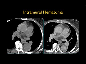 1.6K views · 80 reactions | Intramural Hematoma View the images here: https://www.ctisus.com/teachingfiles/cases/chest/417314 | CTisus: Cutting edge information on body CT (Computed tomography). | Facebook