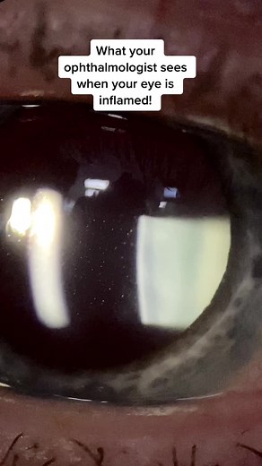 Understanding Uveitis: White Blood Cells in the Eye